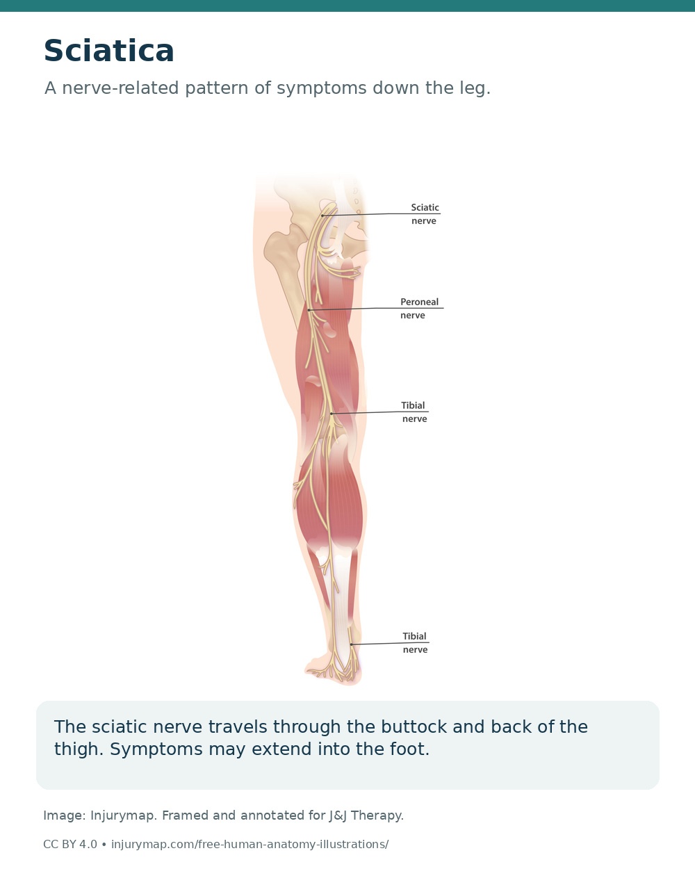 Anatomical illustration of the sciatic nerve continuing through the buttock and thigh into lower-leg branches.