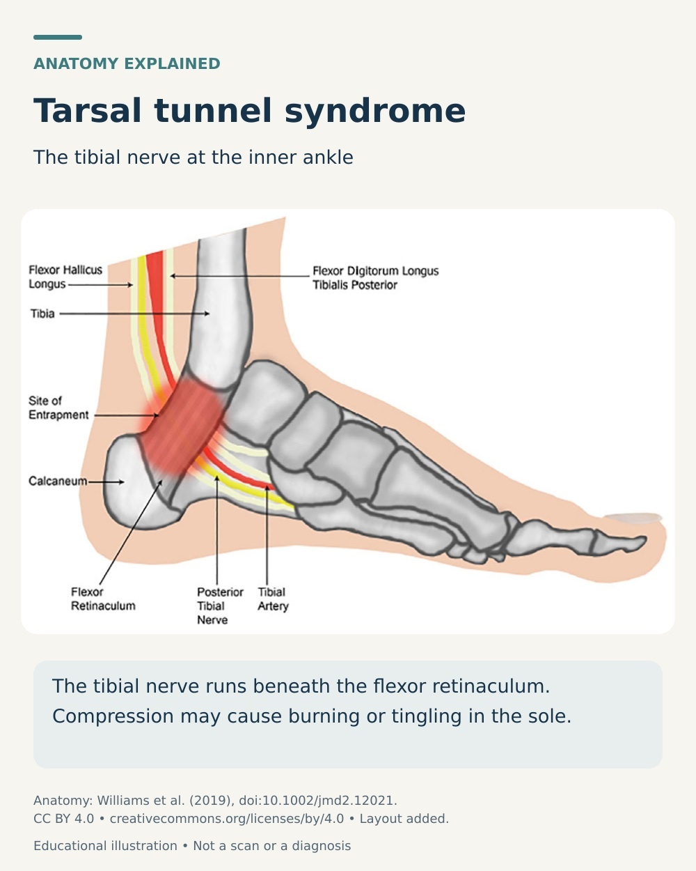 Medial foot anatomy showing the tibial nerve passing beneath the flexor retinaculum and the site of tarsal tunnel entrapment.