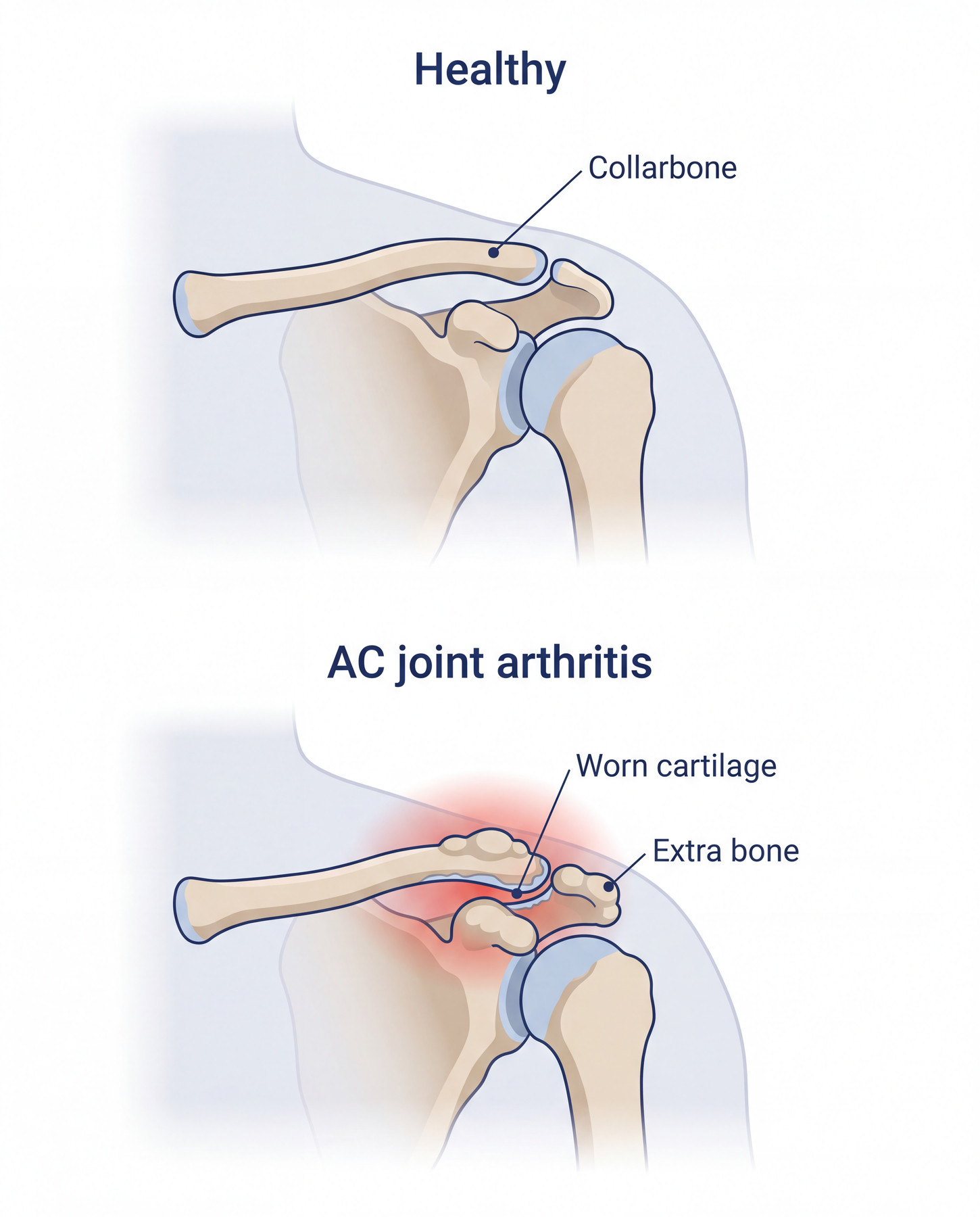 Diagram comparing a normal acromioclavicular joint with cartilage loss and extra bone at the AC joint.