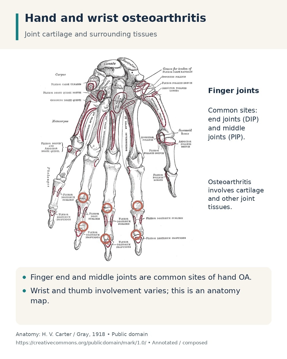 Hand bones with finger end and middle joints highlighted as common sites of osteoarthritis.