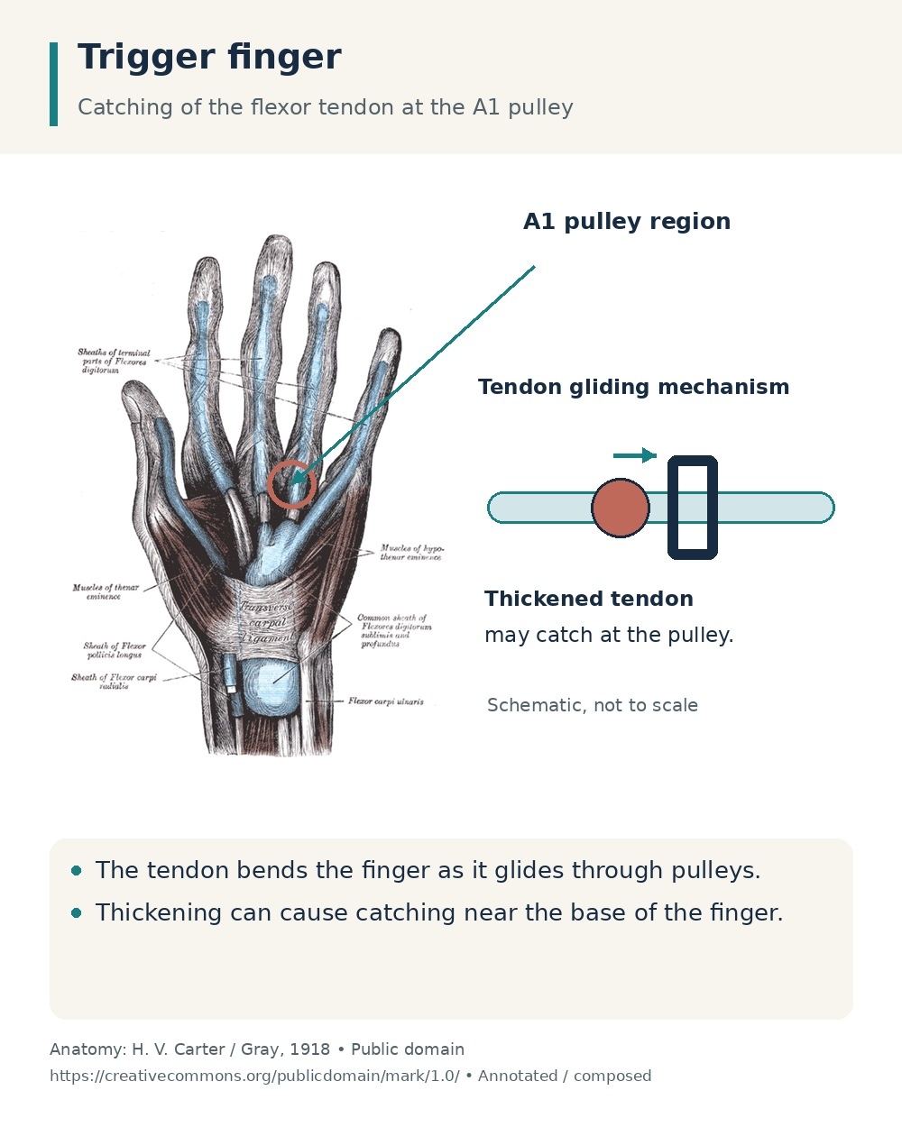 Palmar flexor tendons and the A1 pulley region, beside a schematic of tendon thickening catching at a pulley.