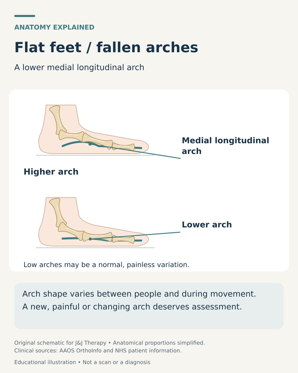 Comparison of higher and lower medial longitudinal foot arches, illustrating that low arches can be a painless variation.