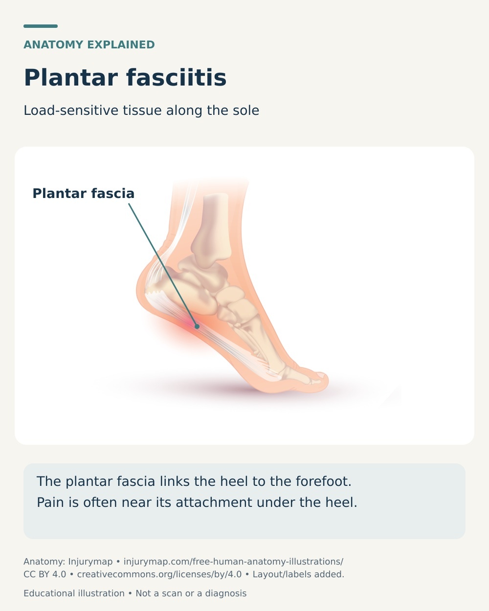 Foot cutaway showing the plantar fascia along the sole and the region near its heel attachment affected by plantar fasciitis.