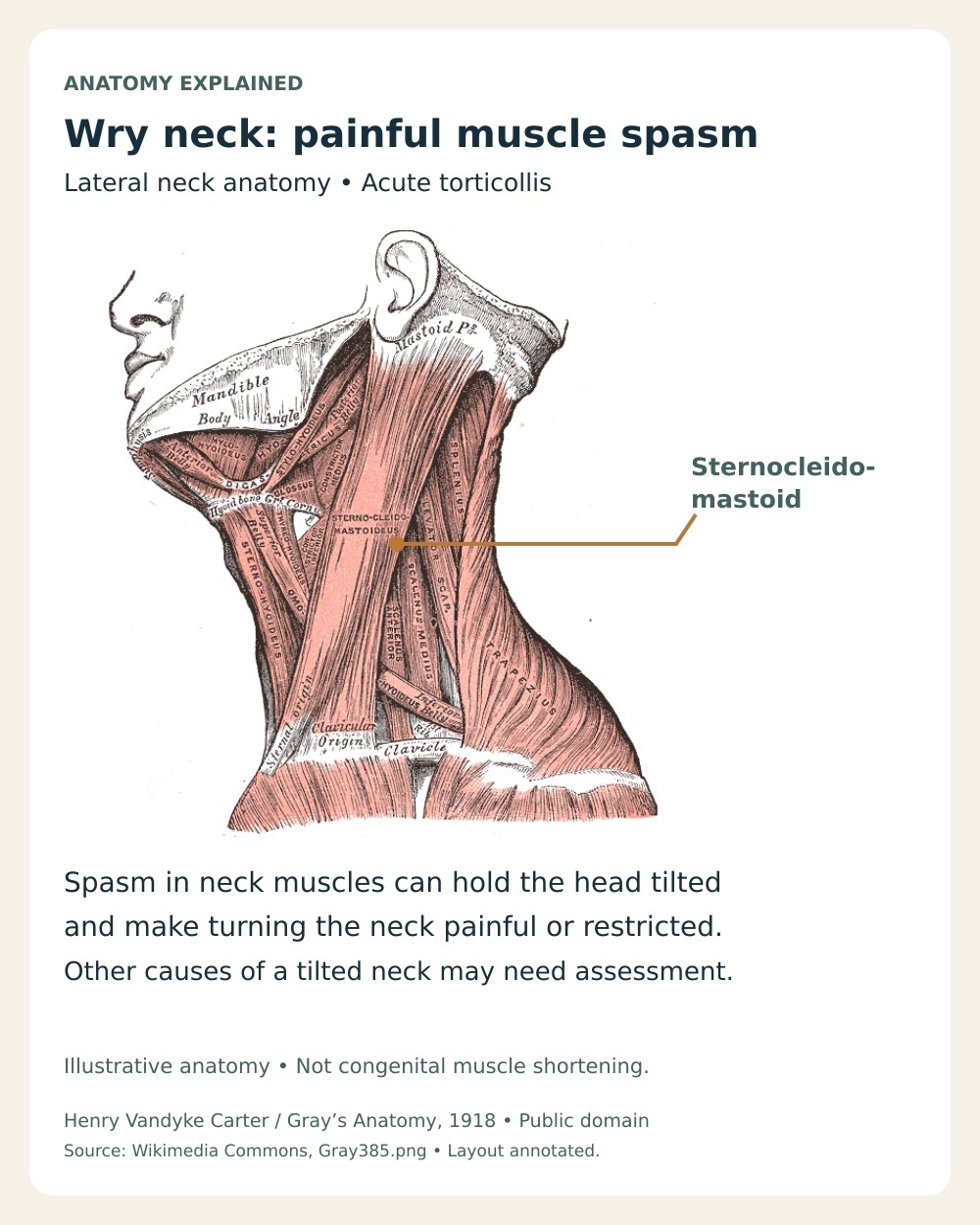 Acute torticollis anatomy highlighting the sternocleidomastoid and explaining how neck muscle spasm can hold the head tilted.
