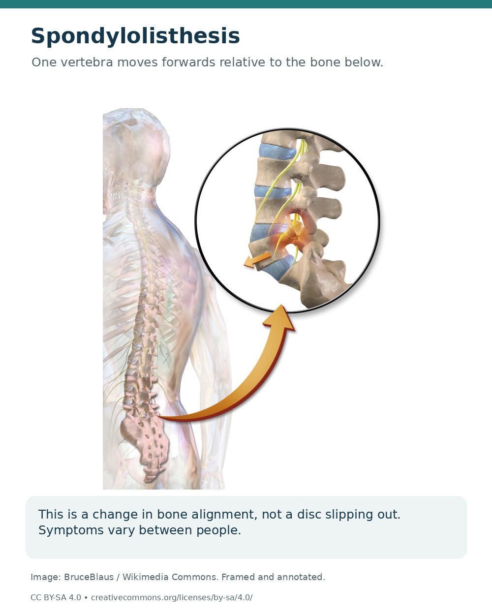 Side view of the lower spine showing one vertebra translated forwards relative to the one below.