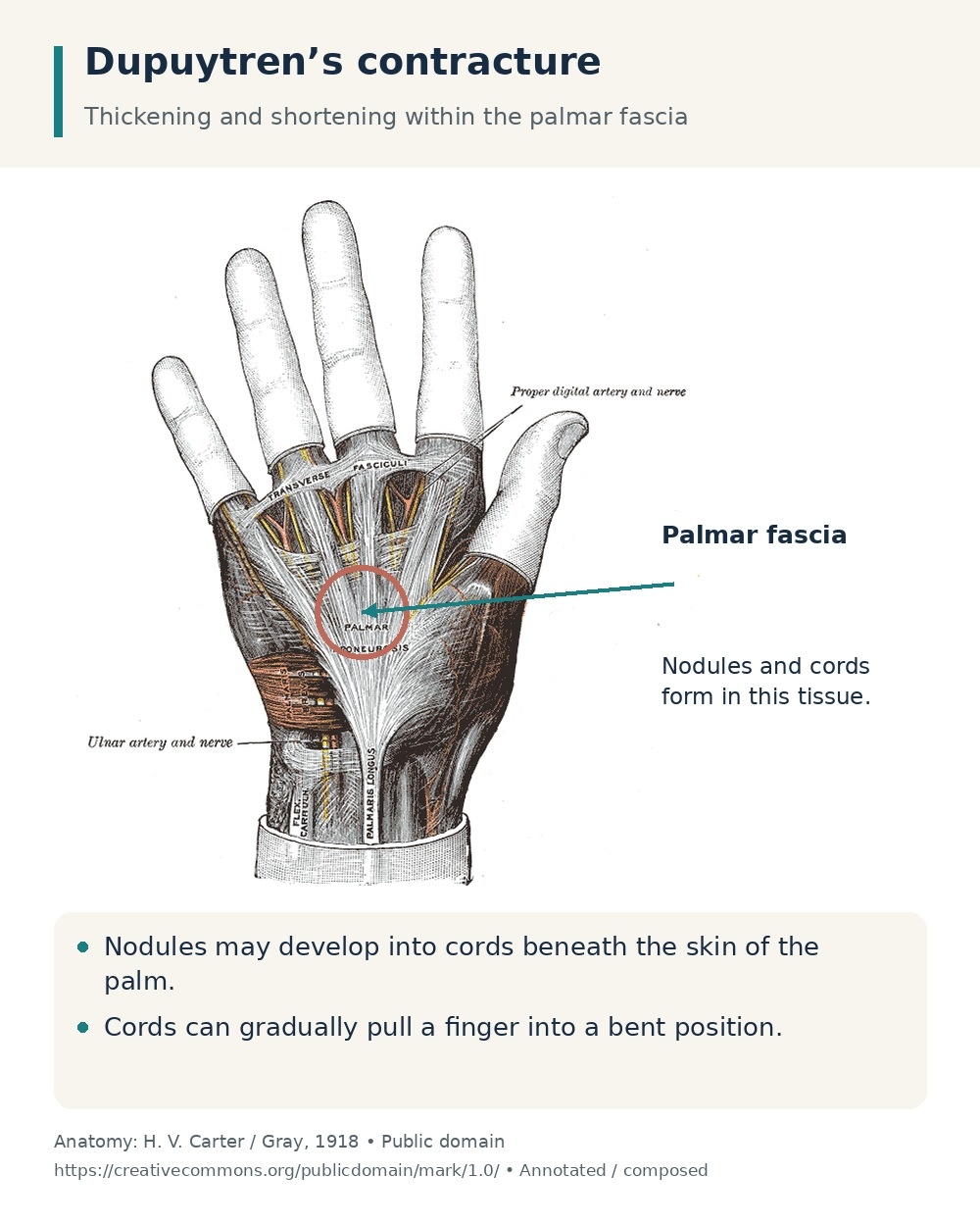 Palmar fascia highlighted beneath the skin, where Dupuytren’s nodules and cords develop.