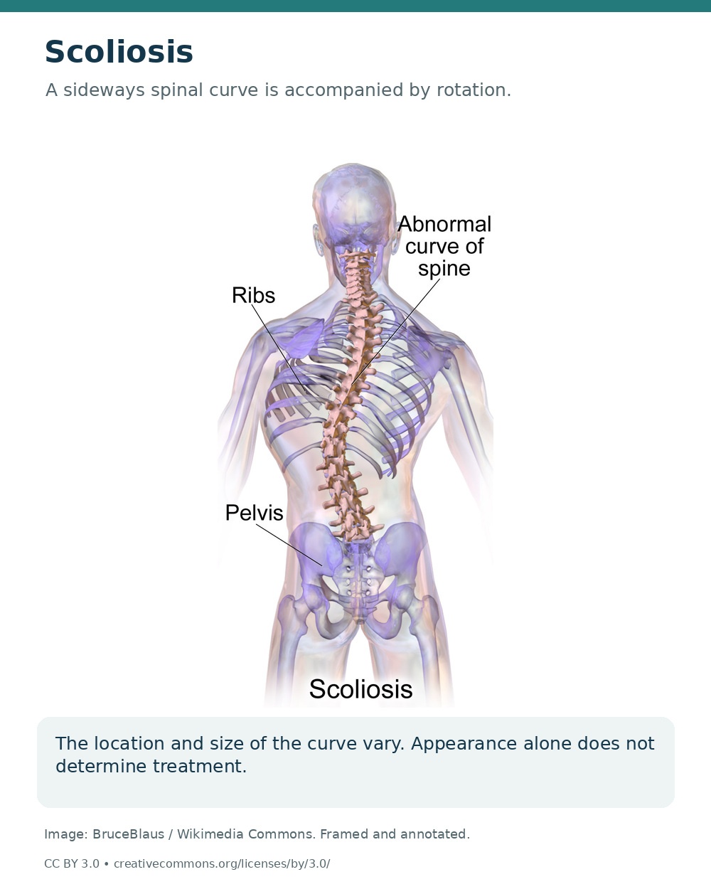 Posterior spinal anatomy showing a sideways curved spine, rib cage and pelvis in scoliosis.