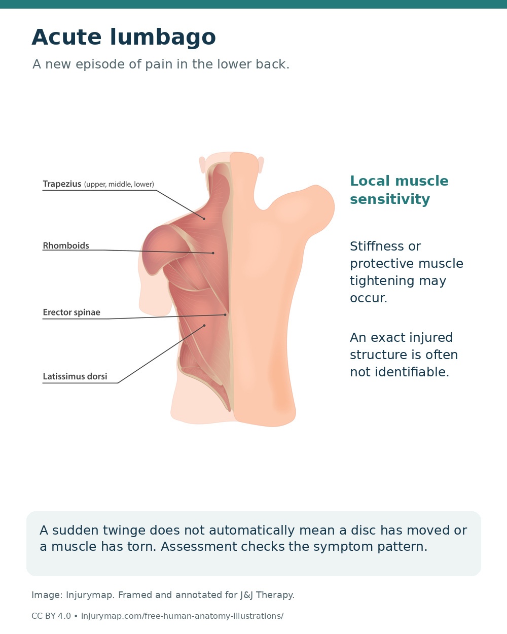 Back muscle anatomy with an explanation of local sensitivity and protective tightening during acute lower-back pain.