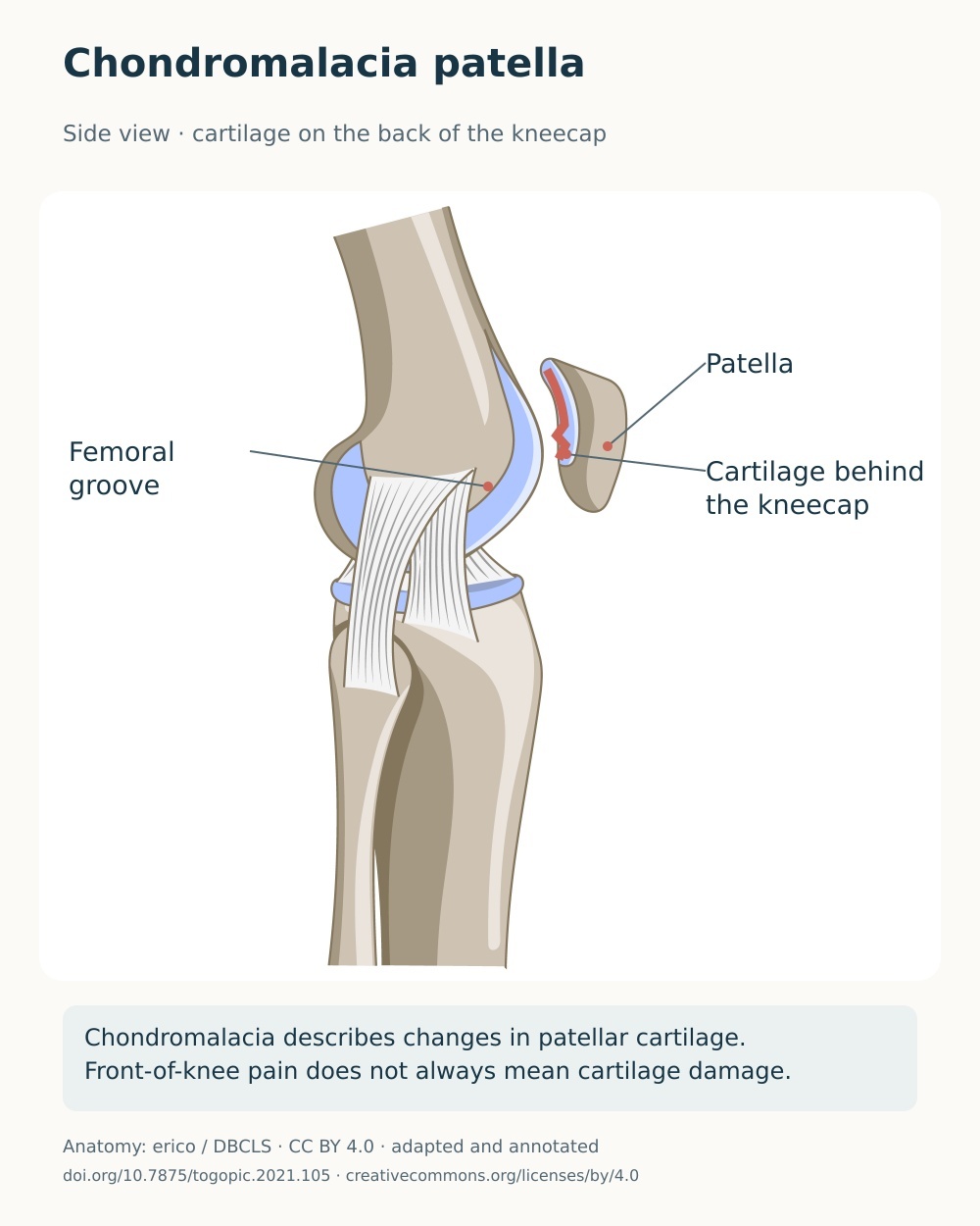 Lateral knee anatomy highlighting cartilage changes on the back surface of the kneecap.