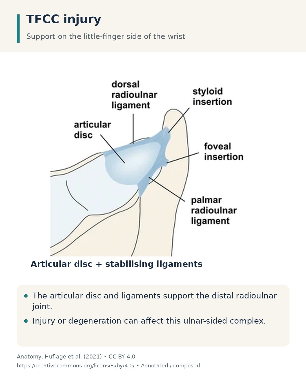 TFCC anatomy showing the articular disc, dorsal and palmar radioulnar ligaments, and styloid and foveal insertions.