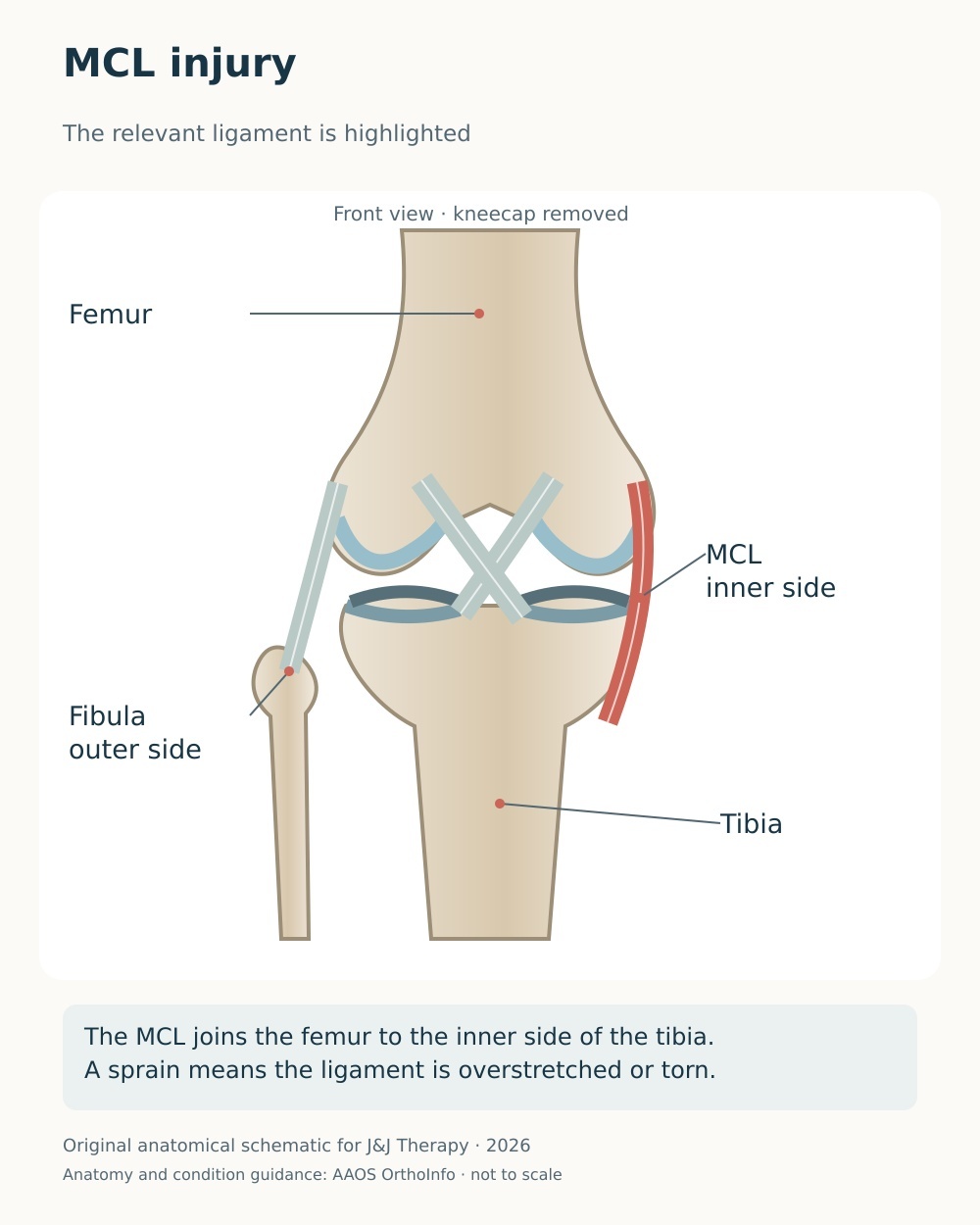 Anterior knee diagram highlighting the medial collateral ligament between the inner femur and tibia.