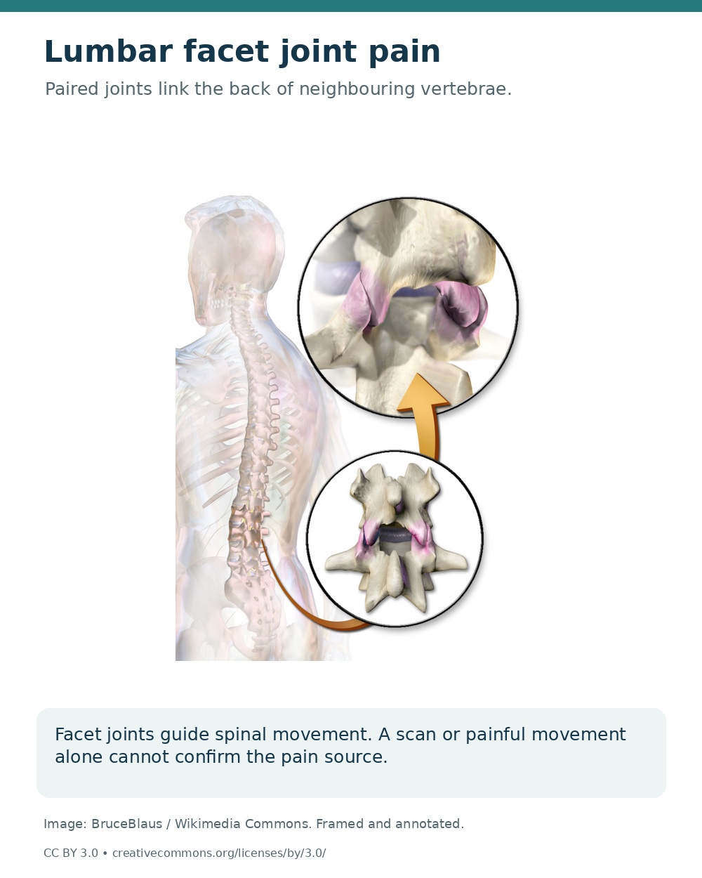 Posterior spinal anatomy with enlarged views of paired facet joints between neighbouring vertebrae.
