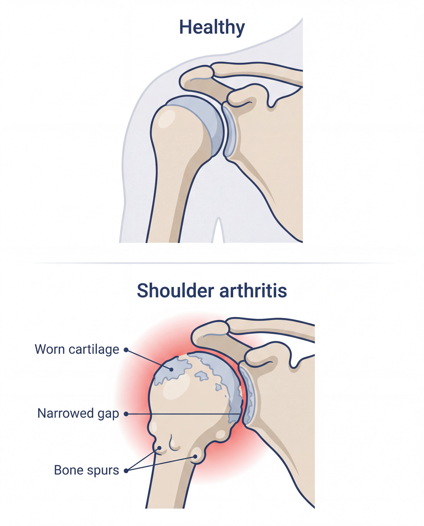 Diagram comparing normal shoulder cartilage with glenohumeral osteoarthritis, narrowing and bone spurs.