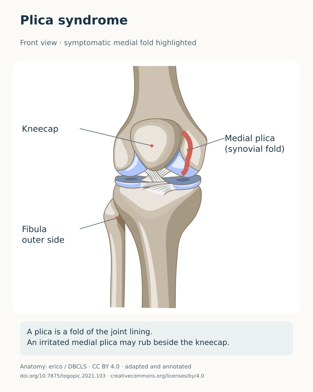 Anterior knee anatomy showing the medial synovial plica beside the inner edge of the kneecap.