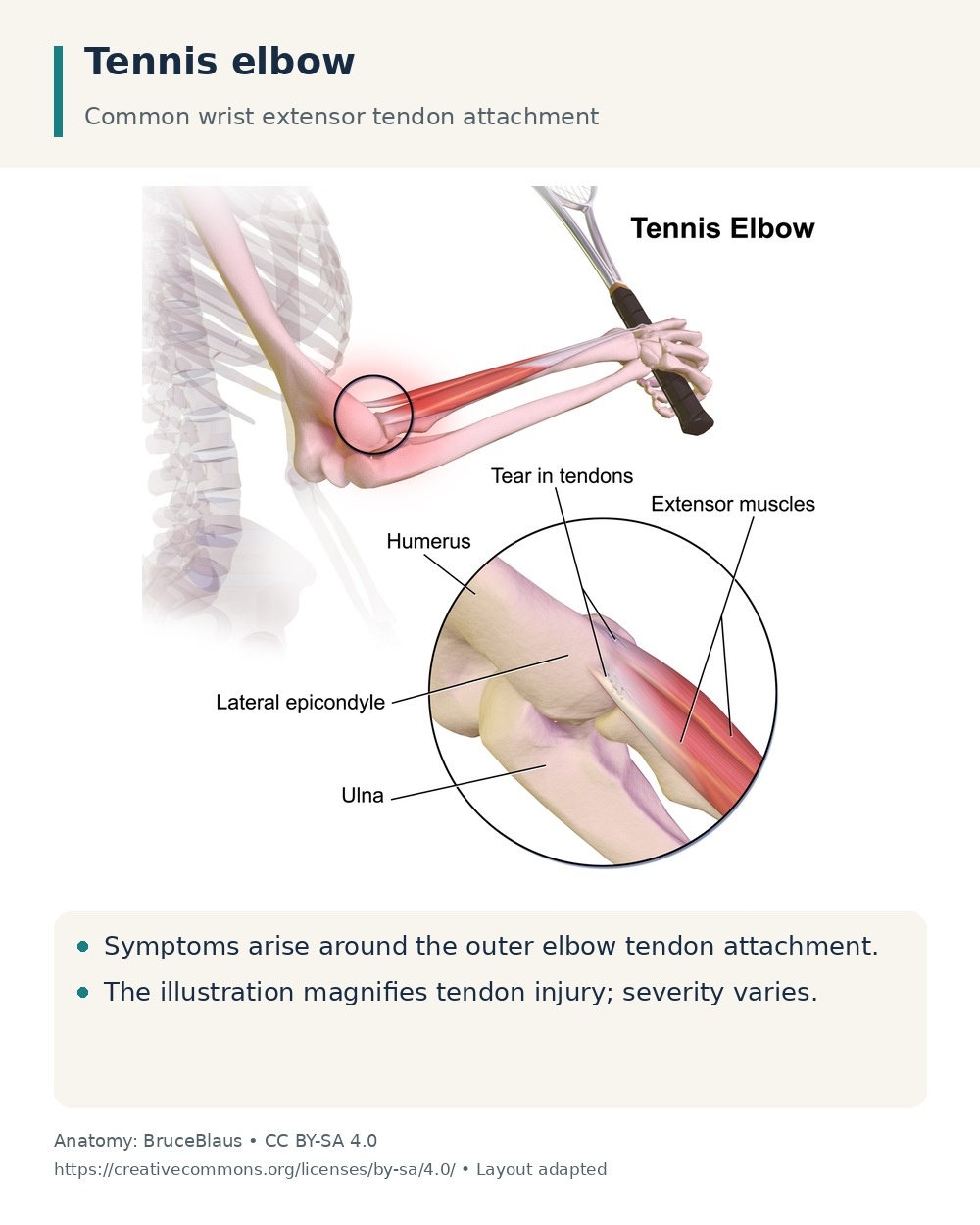 Outer elbow anatomy showing the lateral epicondyle and wrist extensor tendon attachment, with an enlarged tendon-injury inset.