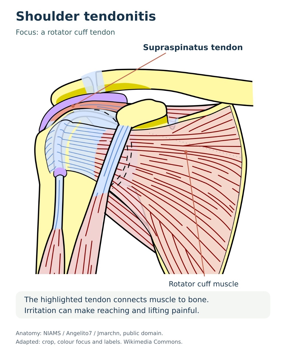 Anatomical diagram highlighting the supraspinatus tendon and a rotator cuff muscle.
