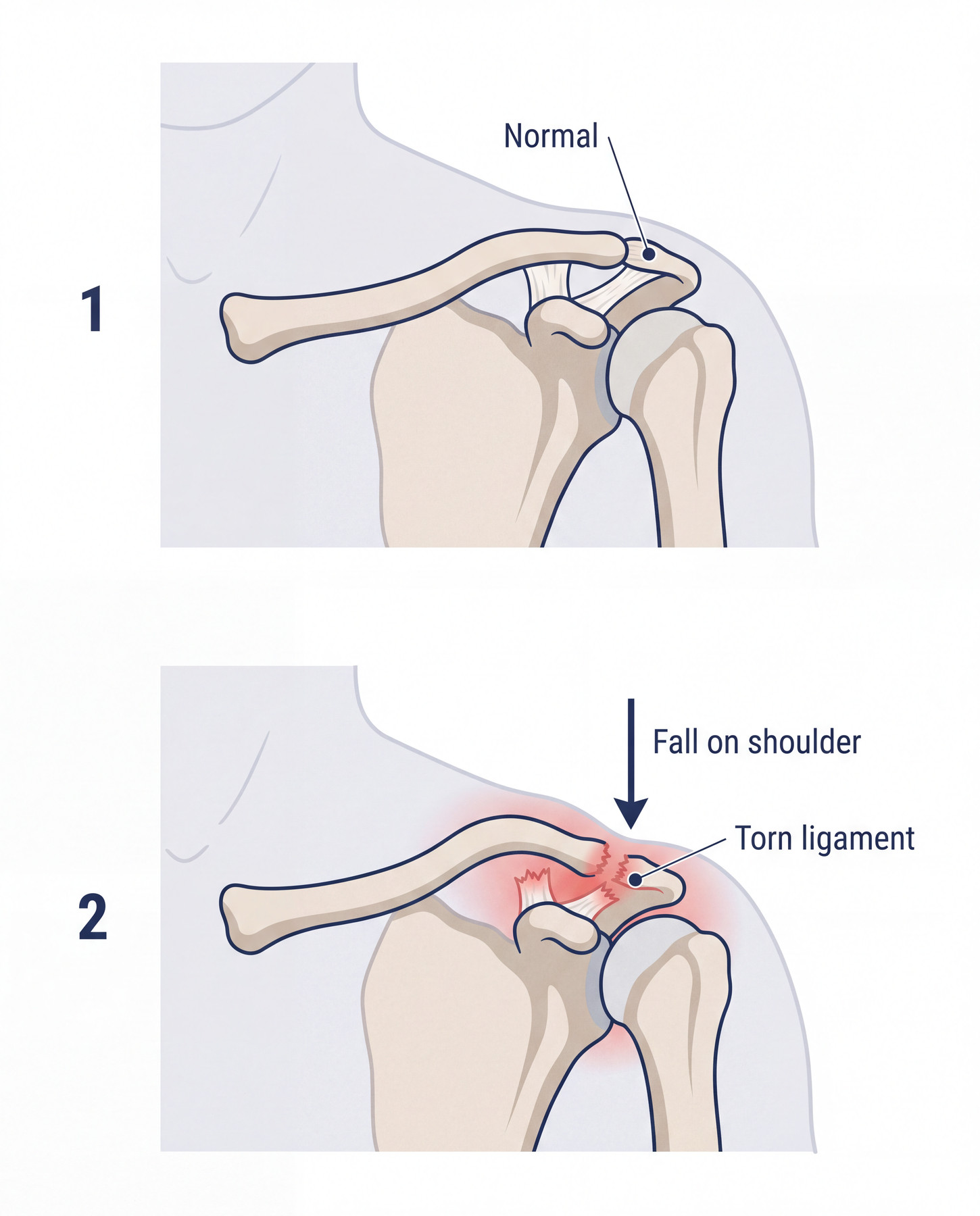 Diagram of an acromioclavicular joint injury showing disruption of the supporting ligaments.