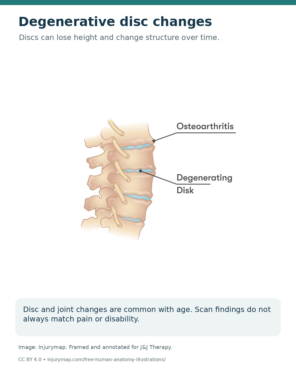 Lumbar vertebrae with reduced disc height and degenerative disc and joint changes.