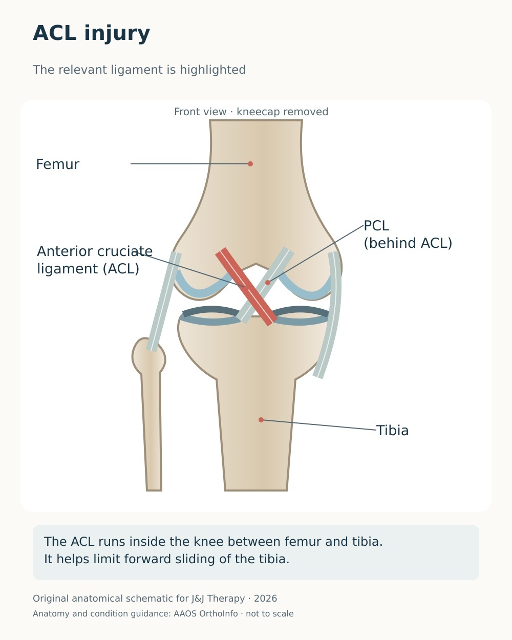 Anterior knee diagram highlighting the ACL inside the joint and distinguishing it from the PCL and collateral ligaments.