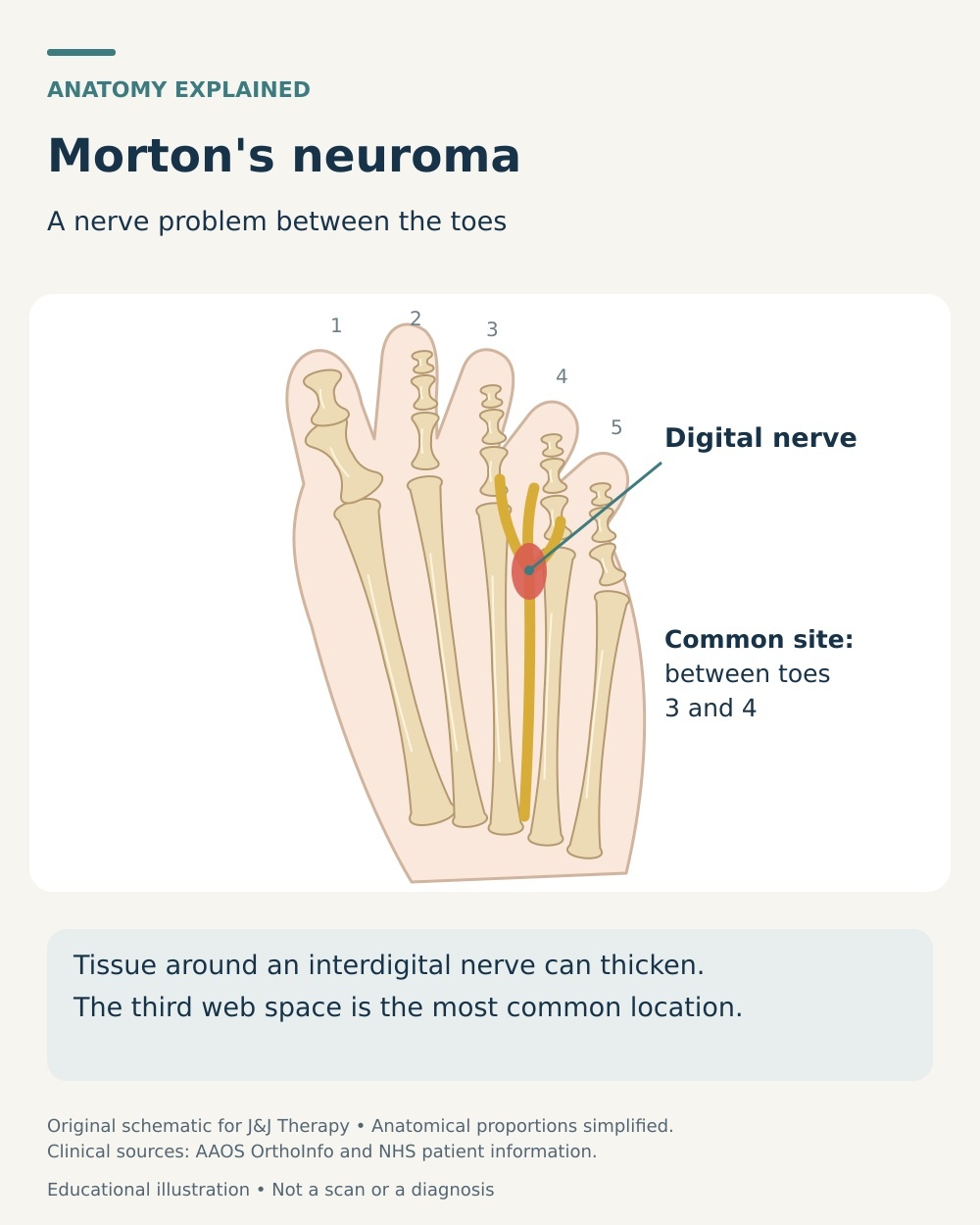 Plantar forefoot diagram showing thickened tissue around a digital nerve between the third and fourth metatarsal heads.