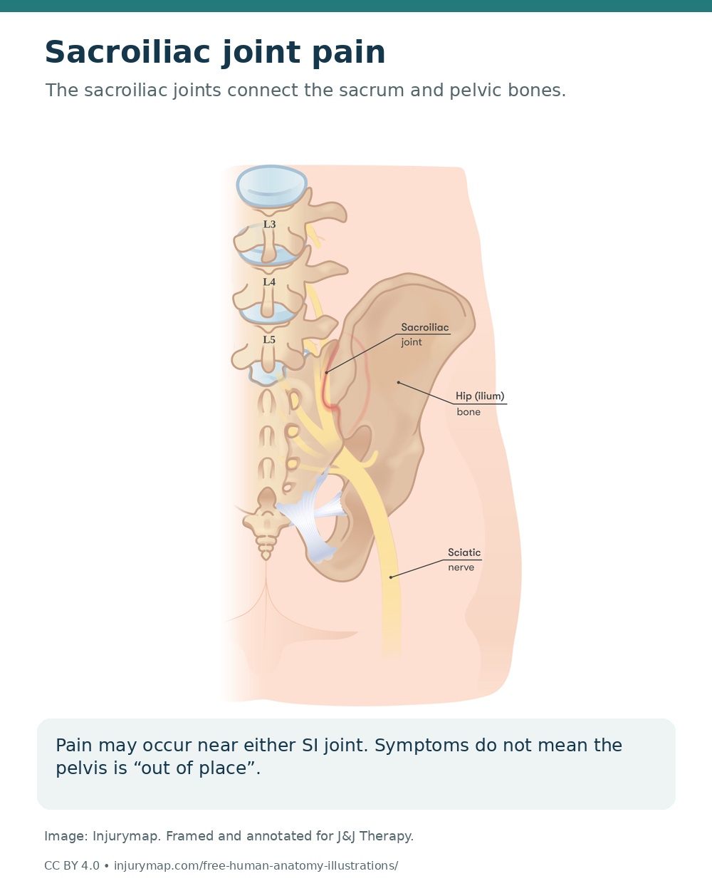 Pelvic anatomy identifying the sacroiliac joints between the sacrum and the pelvic bones.