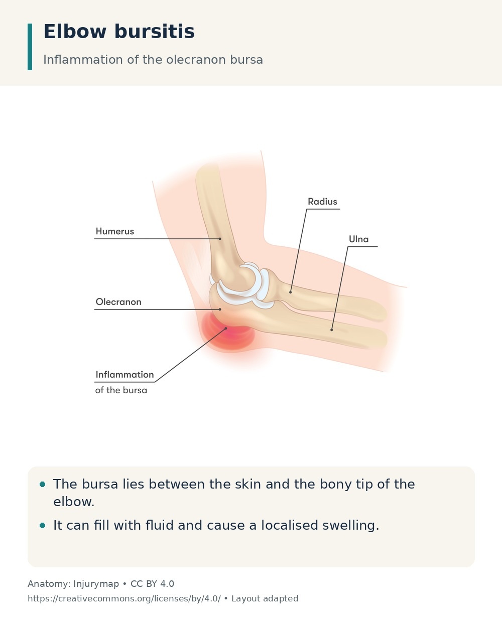 Elbow anatomy showing an inflamed olecranon bursa between the skin and the bony tip of the elbow.