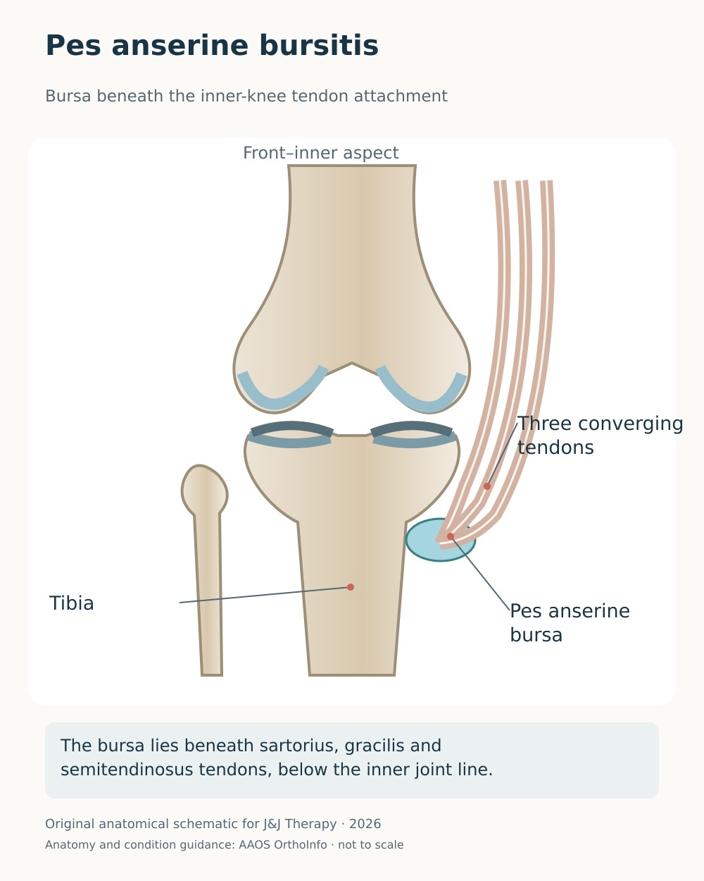 Anterior-medial knee diagram showing the pes anserine bursa beneath three tendons on the upper inner tibia.