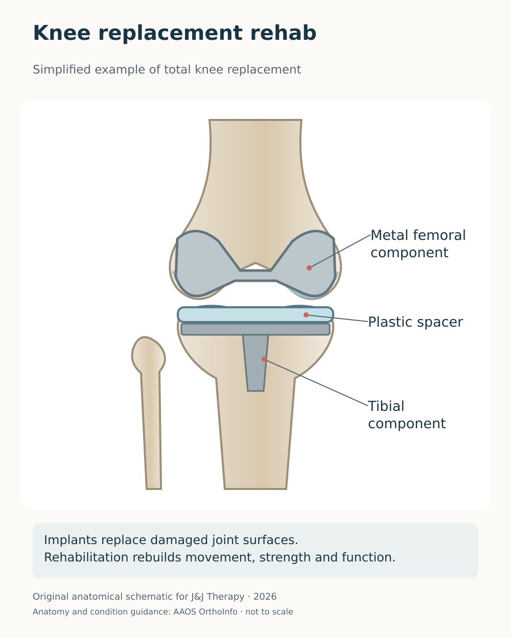 Simplified knee-replacement diagram labelling the metal femoral component, plastic spacer and tibial component.
