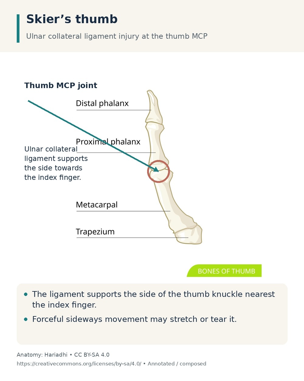 Thumb bones with the MCP joint highlighted and the index-facing location of the ulnar collateral ligament explained.