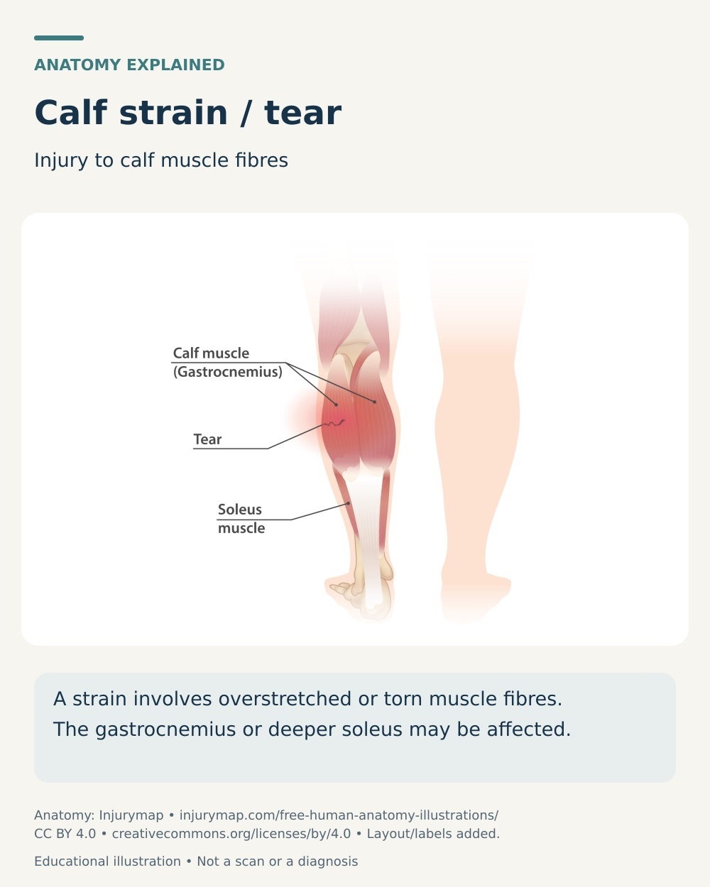 Calf muscle cutaway showing gastrocnemius and soleus anatomy with a local muscle strain or tear.
