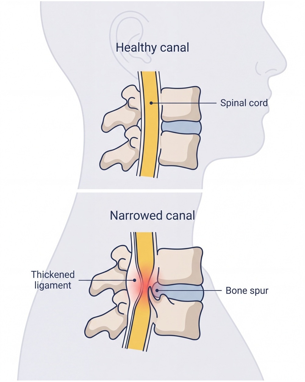Simplified comparison showing the cervical spinal canal and an example of narrowing.