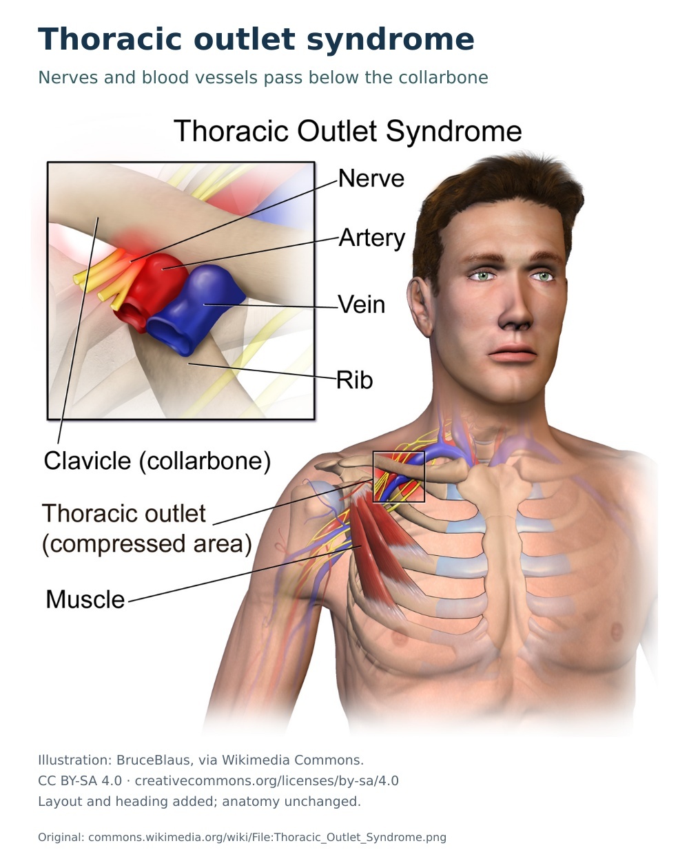Thoracic outlet diagram showing nerves, artery and vein between the collarbone and first rib.