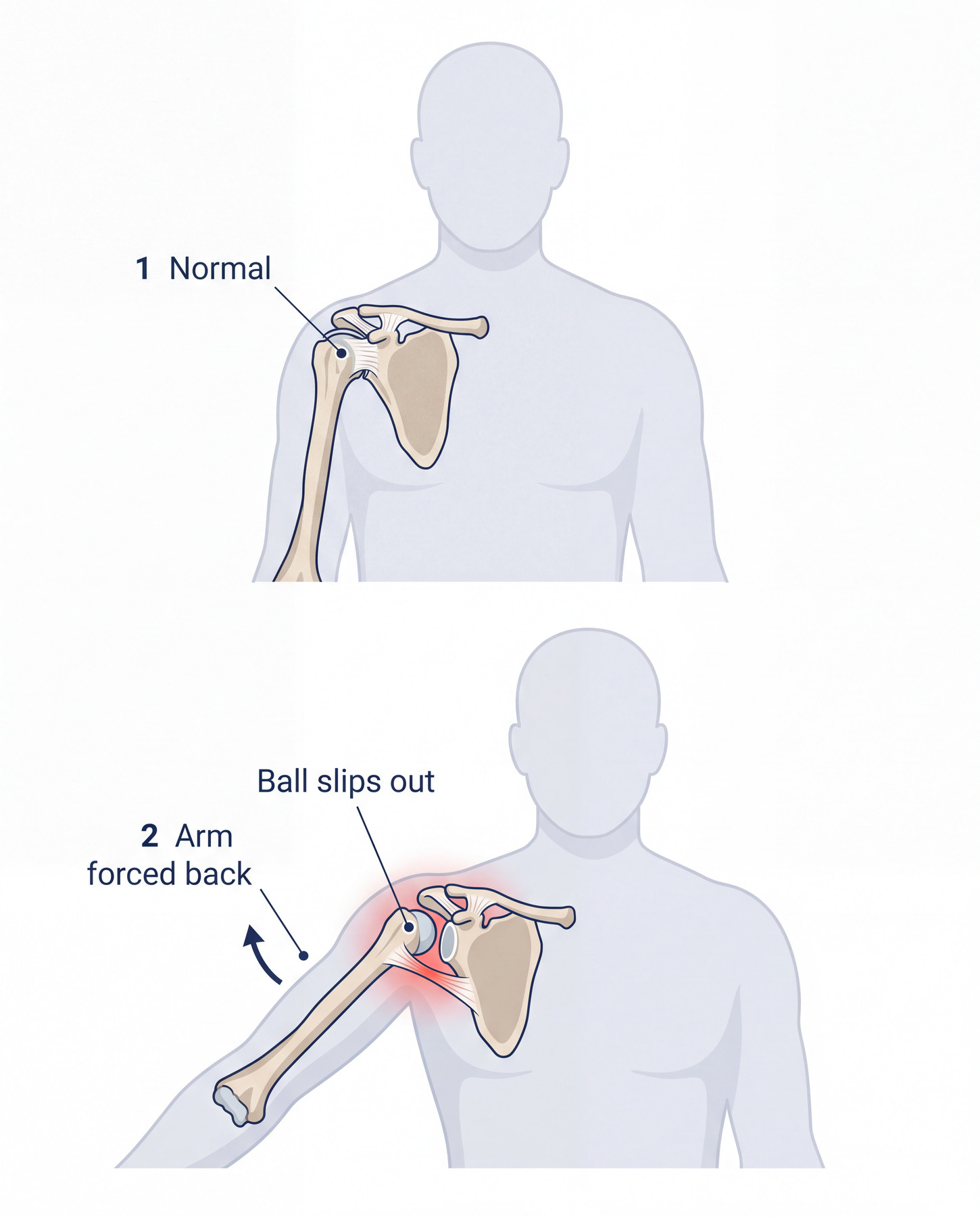 Diagram comparing a shoulder in its socket with the upper arm bone slipping out during dislocation.