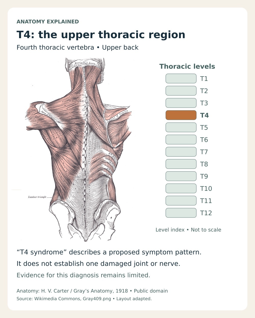 Upper thoracic anatomy beside a schematic T1 to T12 level index highlighting T4, with an explanation of the limited evidence for T4 syndrome.