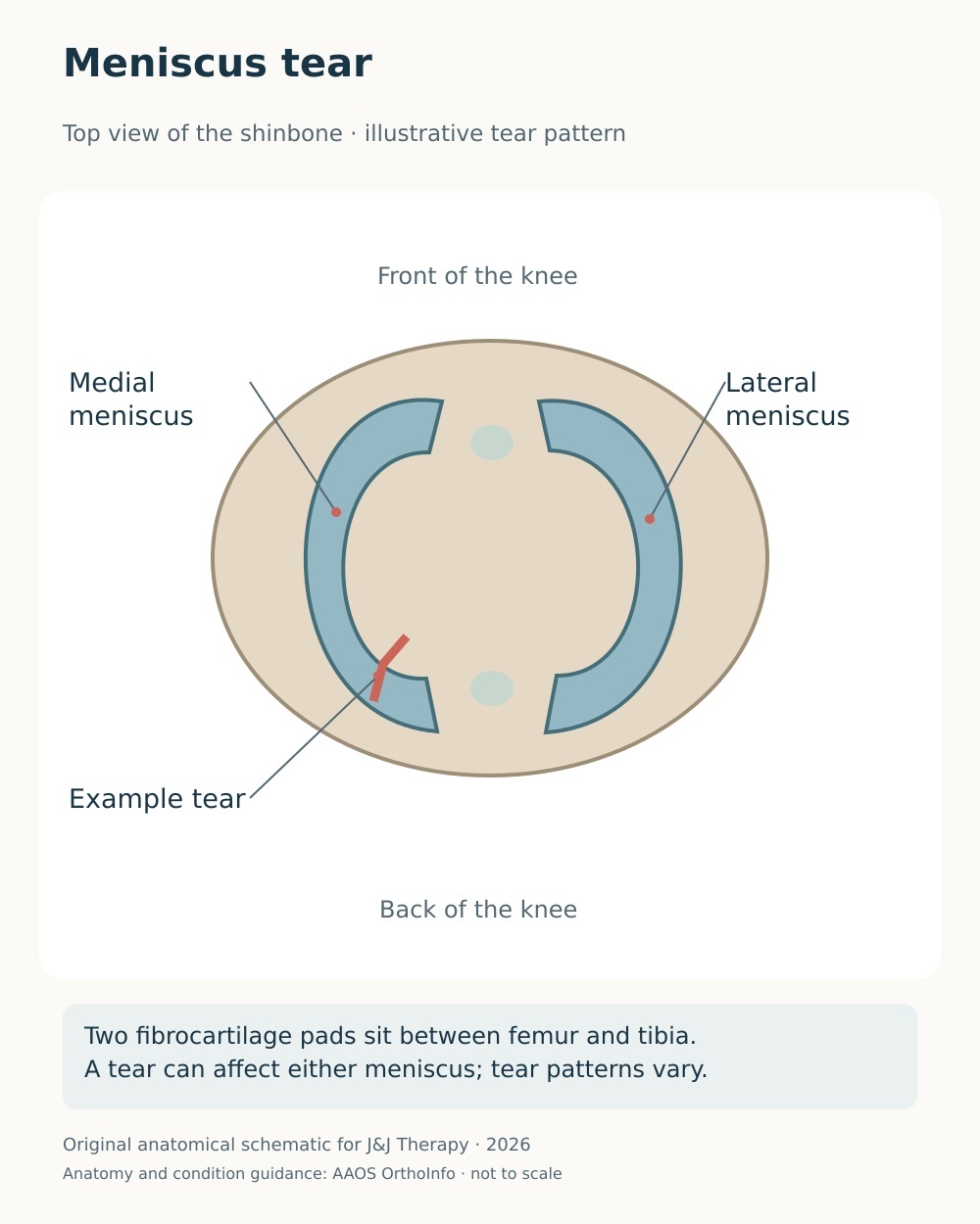 Top-down tibial-plateau diagram showing the two menisci and an example tear in the medial meniscus.