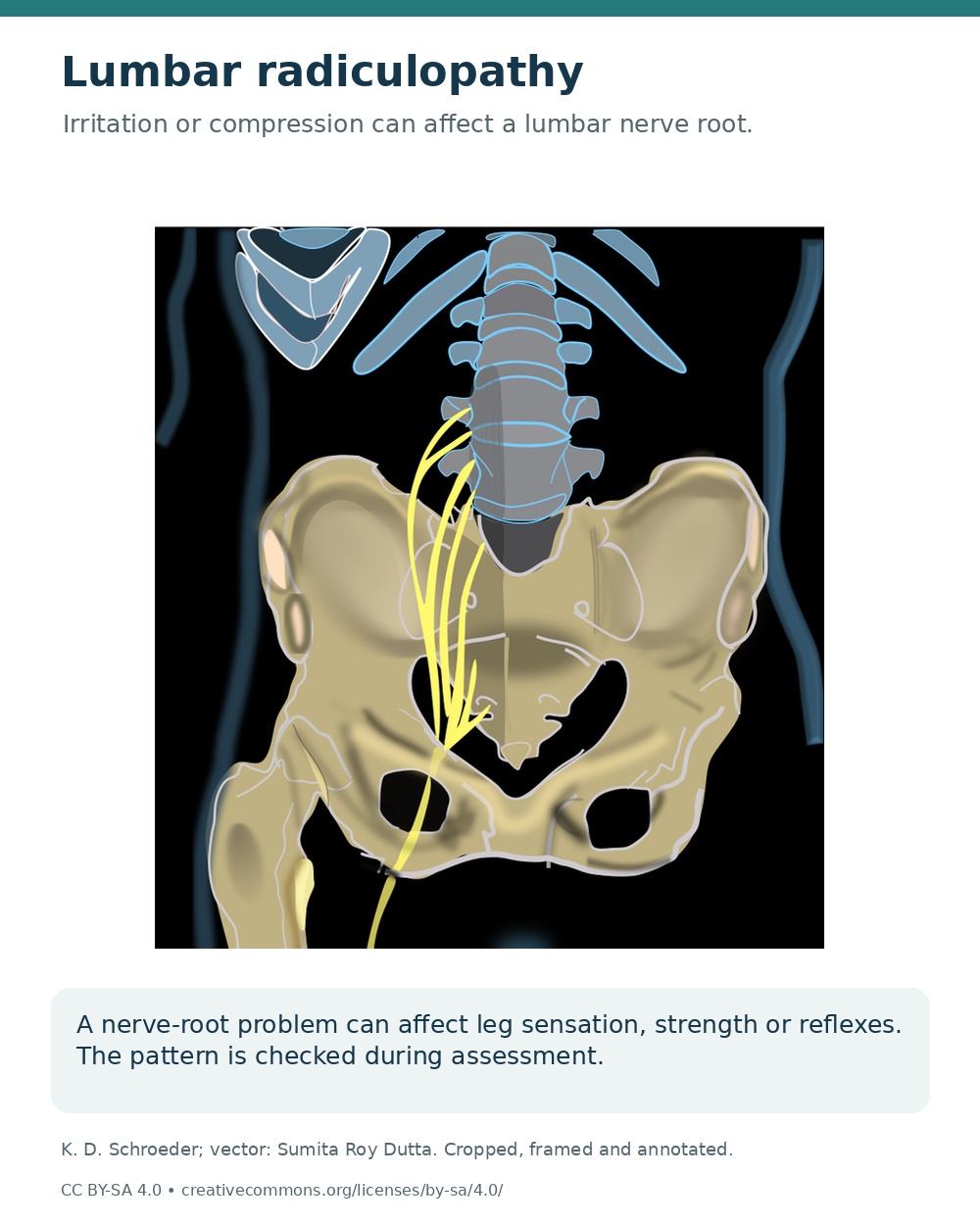 Anatomical illustration of lower spinal nerve roots joining the sciatic nerve, focused on the lumbar and pelvic region.