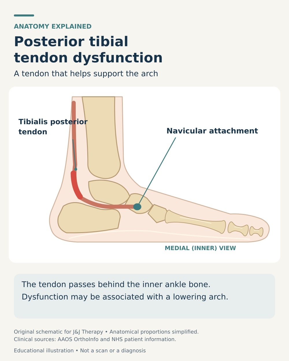Medial ankle anatomy tracing the posterior tibial tendon behind the inner ankle to its navicular attachment.
