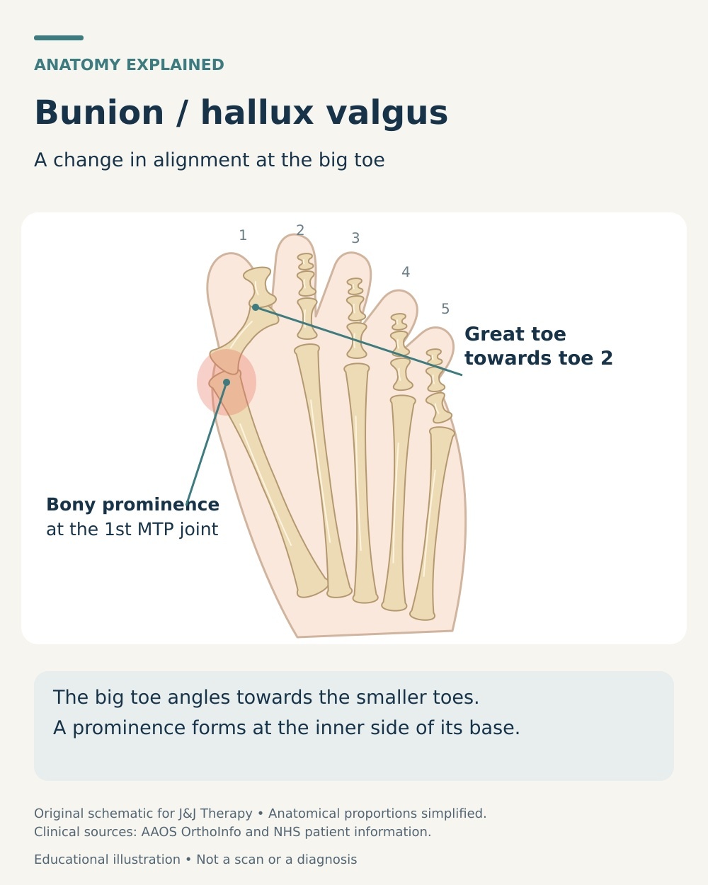 Forefoot anatomy showing the big toe angled toward the second toe and a prominence at the first MTP joint.