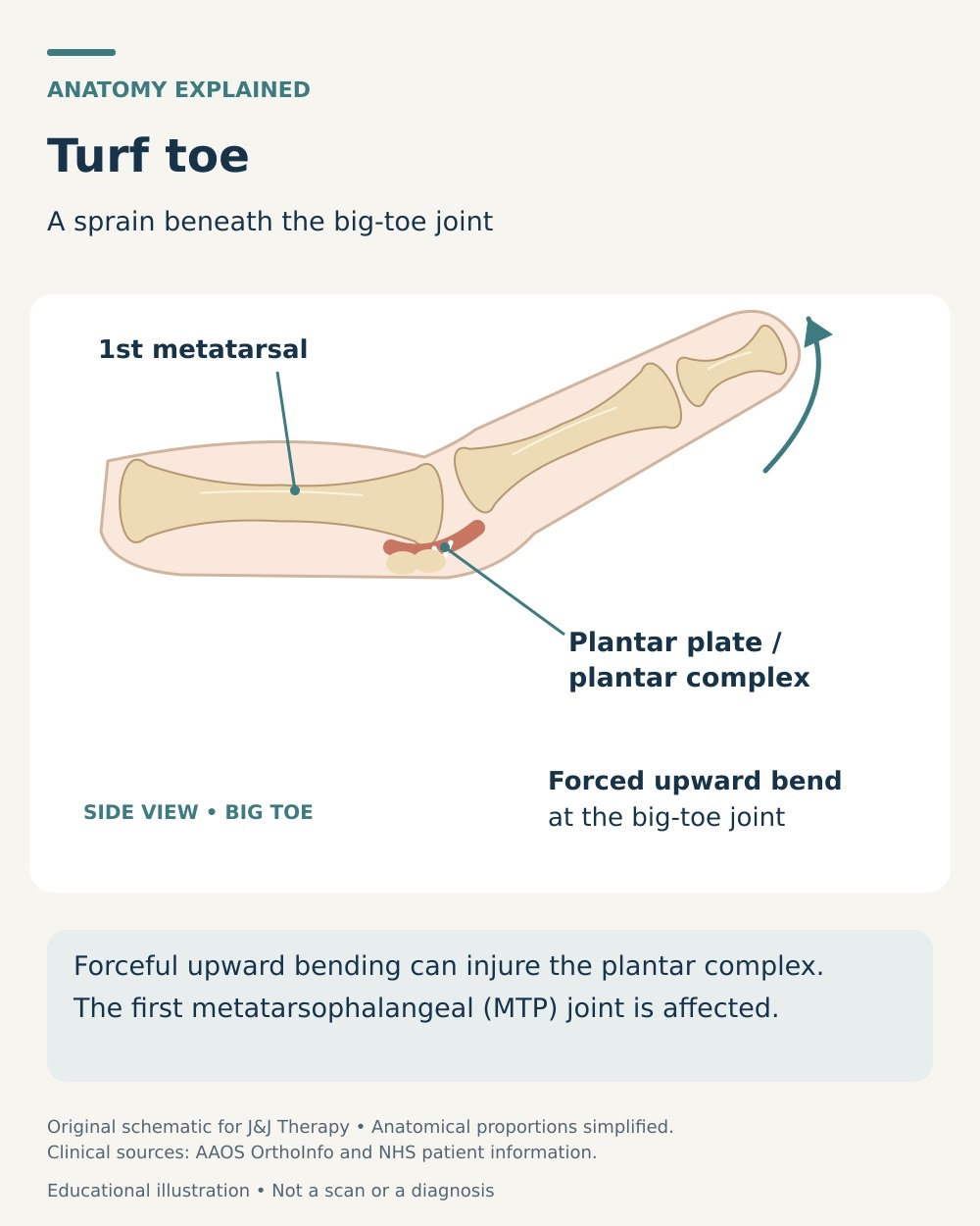Anatomical schematic of turf toe showing upward bending at the first MTP joint and injury to the plantar complex beneath it.