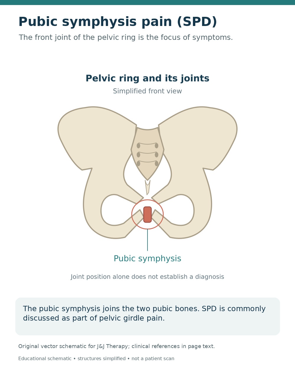Simplified front view of the pelvis highlighting the pubic symphysis between the pubic bones.