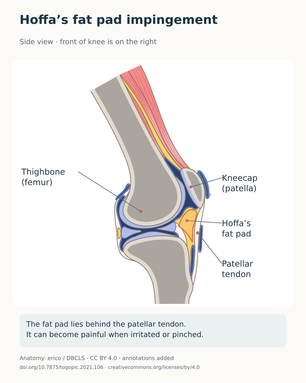 Sagittal knee diagram identifying Hoffa’s fat pad behind the patellar tendon and below the kneecap.