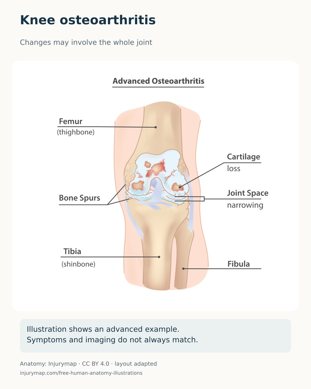 Anatomical illustration of advanced knee osteoarthritis showing cartilage loss, bone spurs and joint-space narrowing.