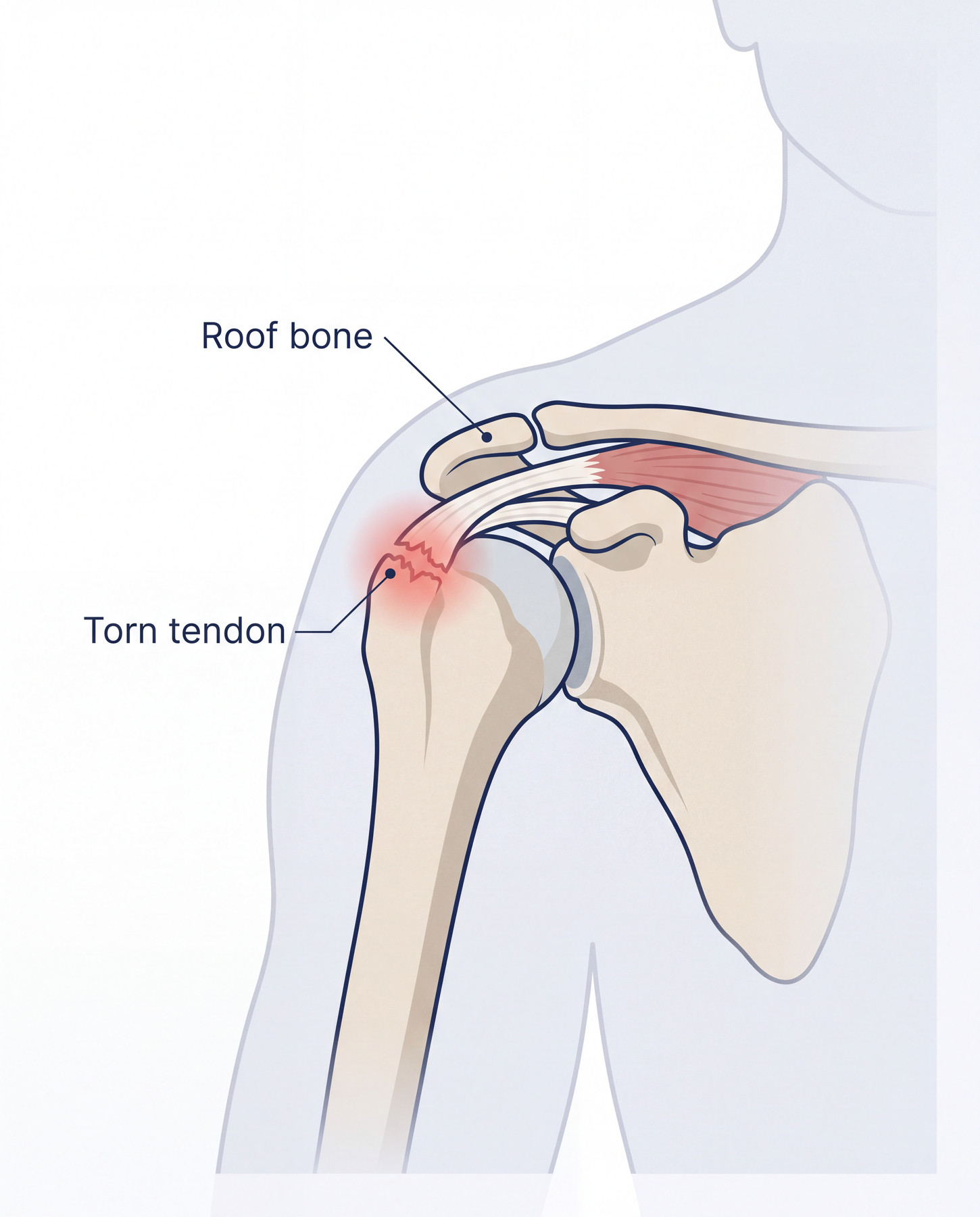 Diagram of a rotator cuff tendon tear near its attachment to the upper arm bone.