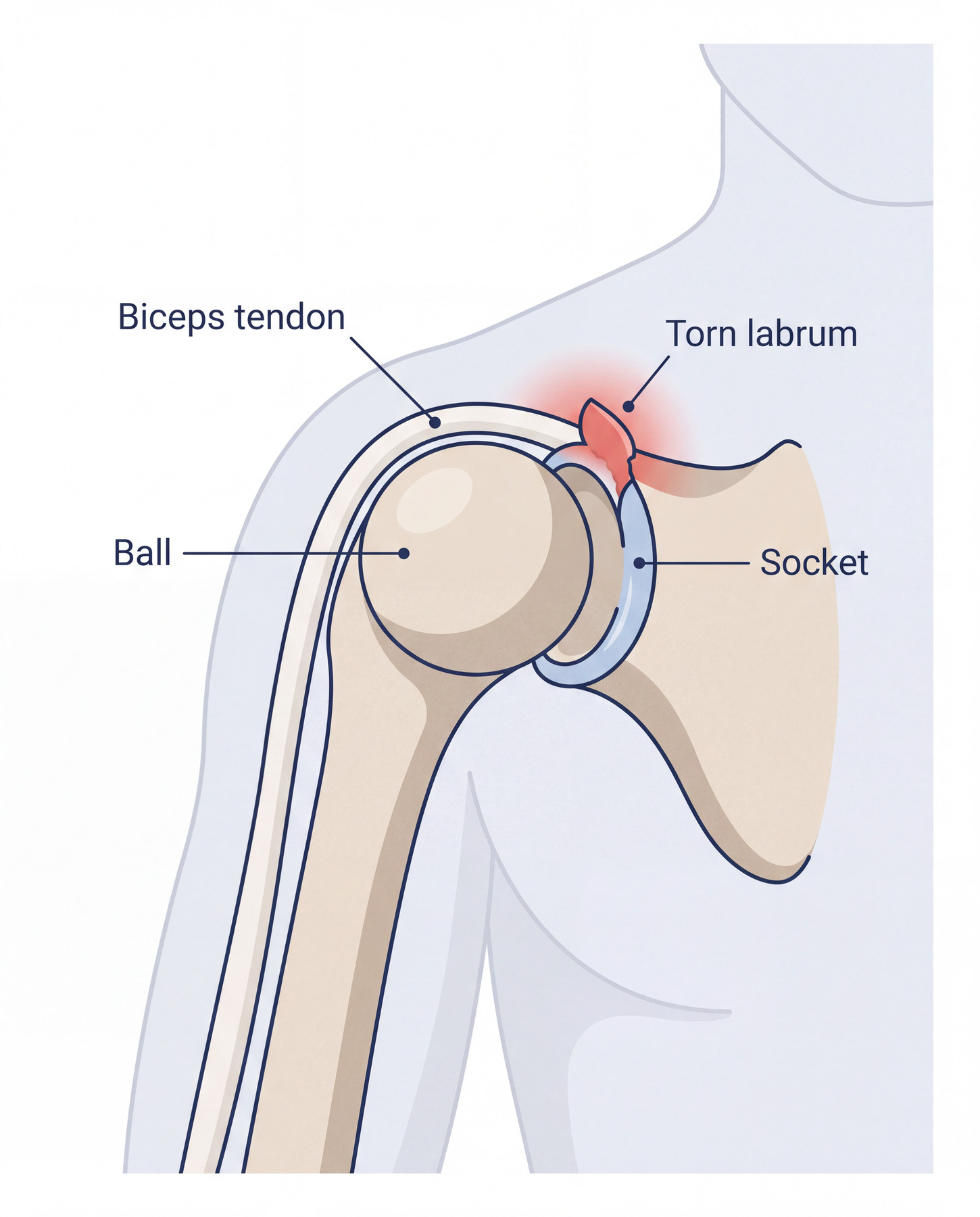 Diagram showing a superior shoulder labral tear near the biceps tendon attachment, an example of a SLAP lesion.