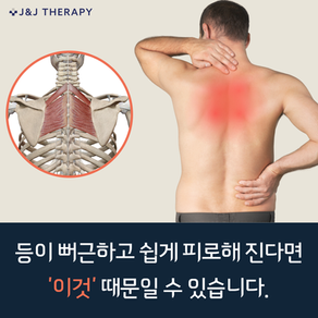 능형근 통증: 중등부가 뻣뻣하고 쉽게 피로해지는 이유
