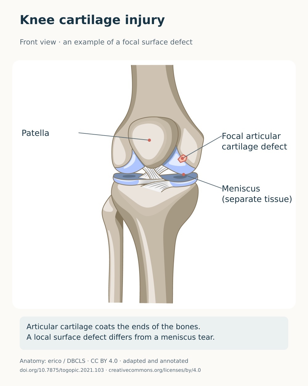Anterior knee anatomy with an example focal articular-cartilage defect on a femoral condyle.