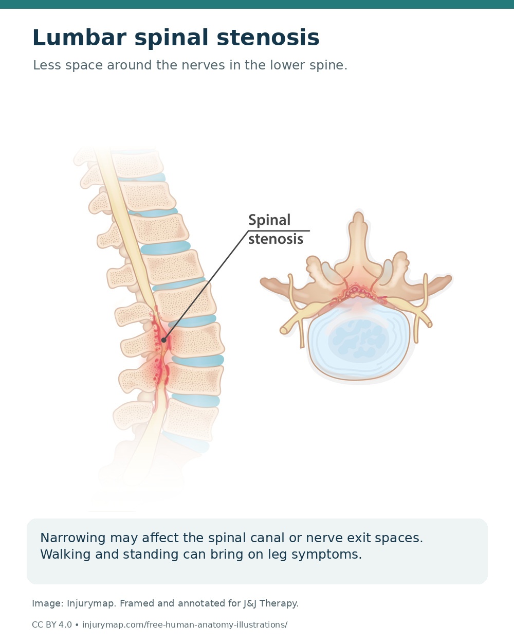 Lumbar spinal stenosis anatomy showing reduced space around the spinal nerves.