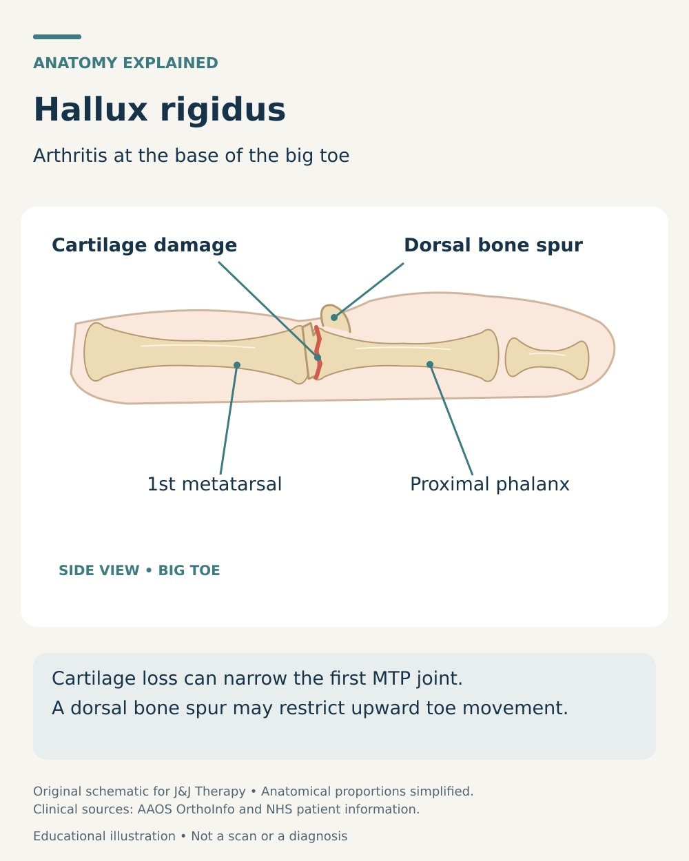 Big-toe joint anatomy showing cartilage damage and a dorsal bone spur in hallux rigidus.
