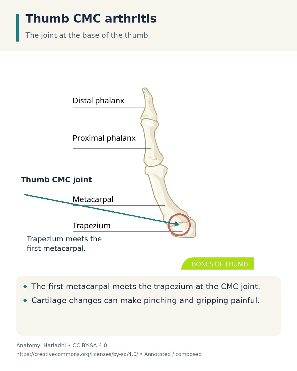 Thumb bones with the CMC joint highlighted where the first metacarpal meets the trapezium.
