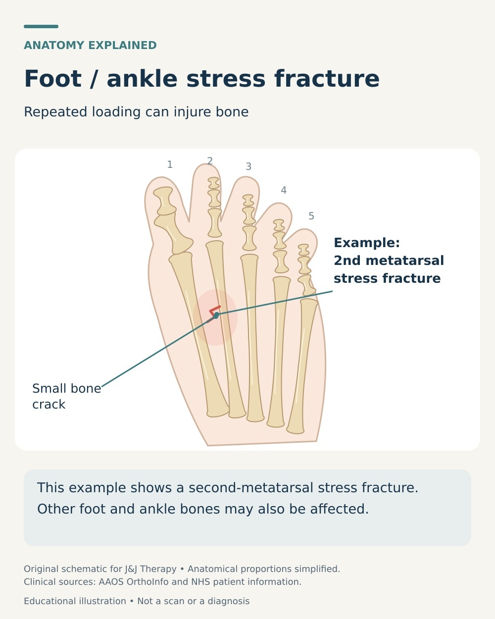 Example of a small stress fracture in the second metatarsal shaft, shown within the five bones of the forefoot.